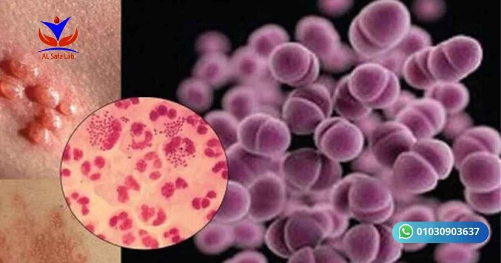 Sexually Transmitted Diseases (STDs)