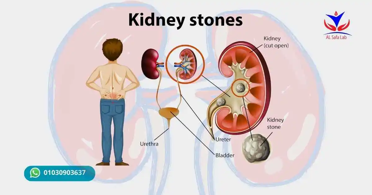 Kidney stones