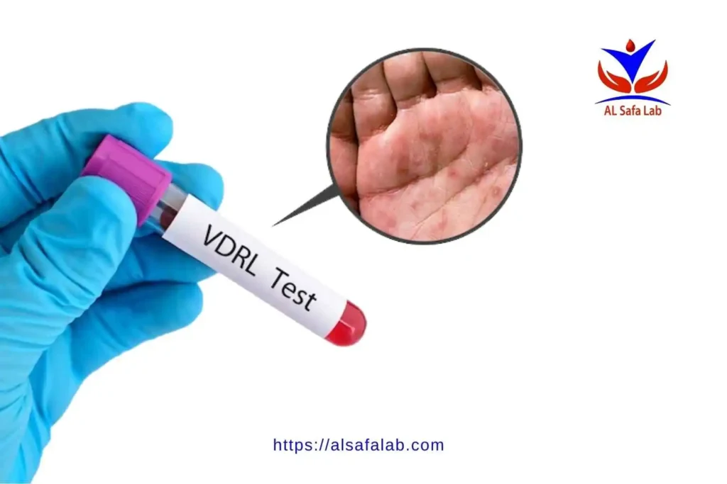 Does the VDRL test detect HIV