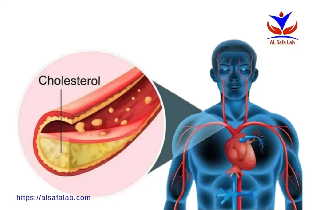 High Cholesterol and Triglycerides Symptoms