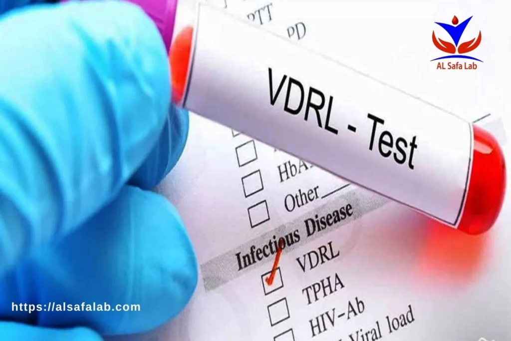 VDRL Lab Test