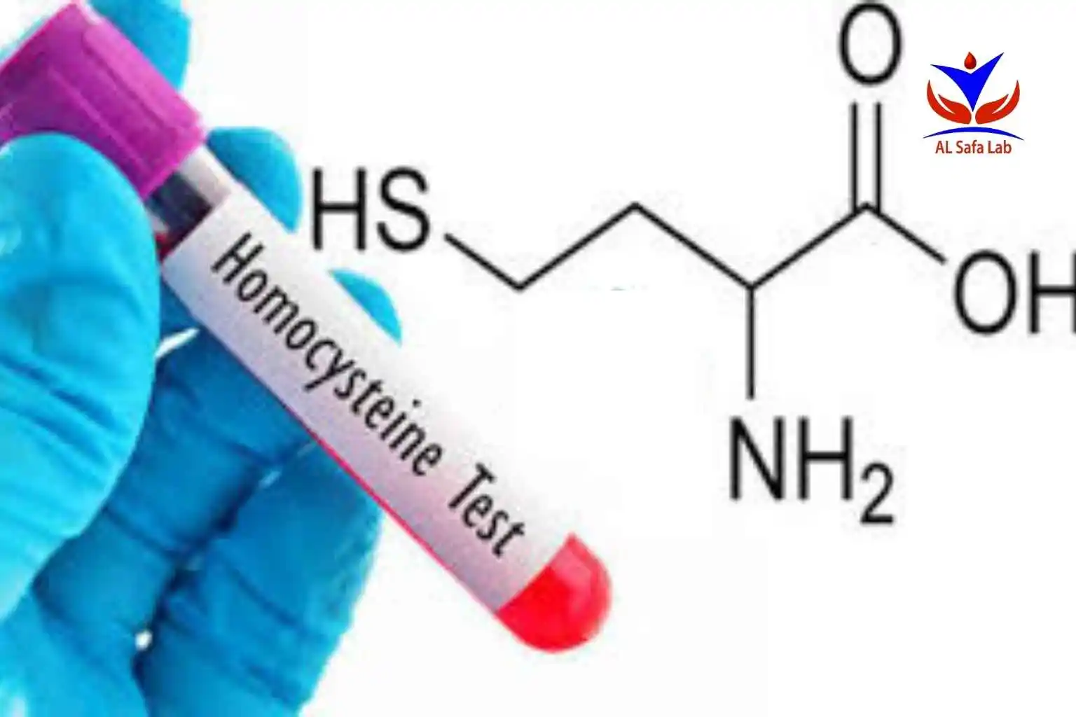 تحليل Homocysteine