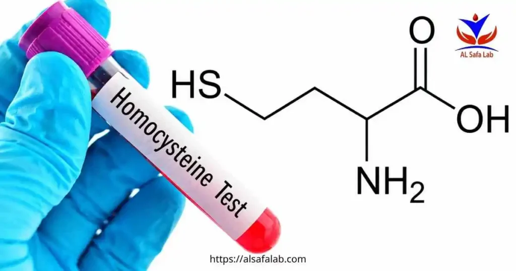 تحليل-homocysteine