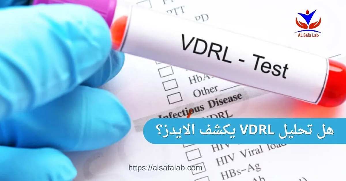 هل تحليل vdrl يكشف الايدز