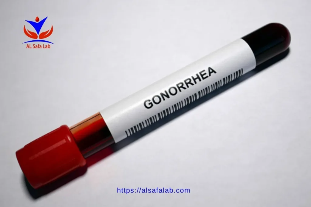 NAAT Gonorrhea Test