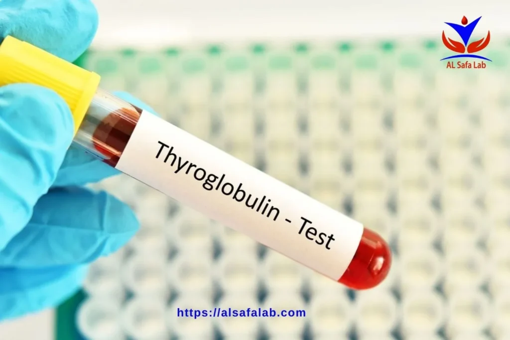 تحليل Anti Thyroglobulin Ab
