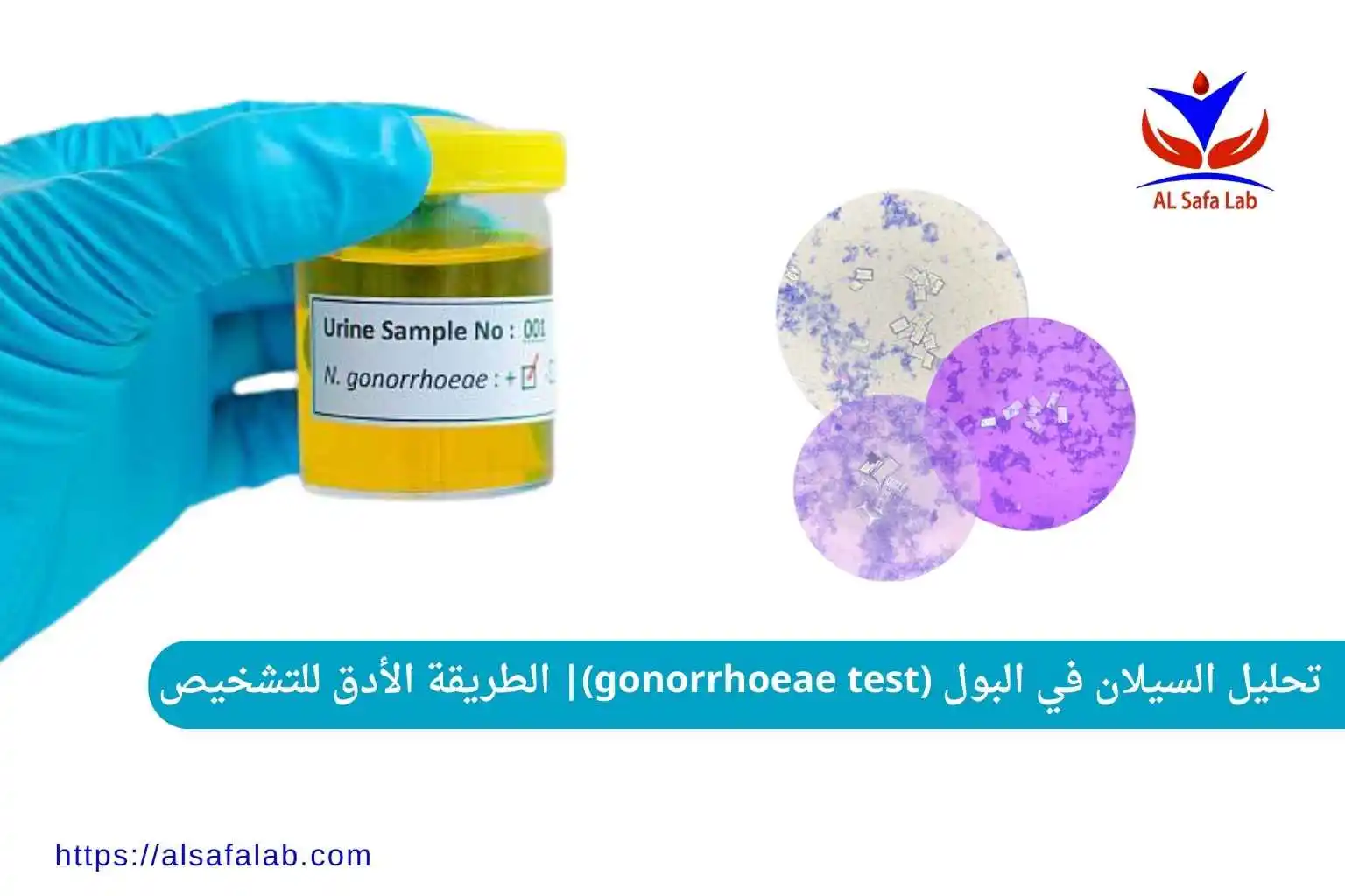 تحليل السيلان في البول